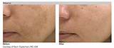 Images of Spectra Peel Laser Treatment