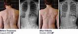 Cobb Angle Scoliosis Treatment Pictures