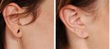 Medical Ear Piercing Clinics Images