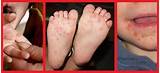 Home Remedies Hand Foot And Mouth Disease Photos