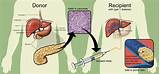 Type 1 Diabetes Experimental Treatment Images