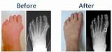 Pictures of Tailor''s Bunion Surgery Recovery