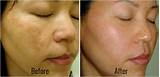 Pictures of Spectra Peel Laser Treatment