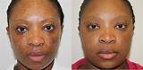Laser Treatment For Acne Scars On Black Skin Images