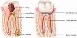Pictures of Alternative To Root Canal Treatment