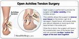 Insertional Achilles Tendonitis Surgery Recovery Time Images