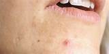 Cystic Acne Under Skin Treatment Images