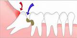 What Can I Take For Wisdom Tooth Pain Images