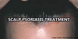 Psoriasis On Your Scalp Treatment Images