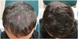 Photos of Which Doctor To See For Hair Loss Treatment