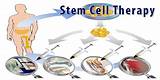 Images of Stem Cell Therapy For Kidney Failure