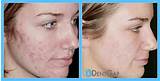 Photos of How Much Is Facial Laser Treatment