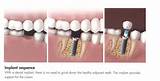 Dental Crown Steps Pictures