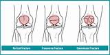 Broken Knee Cap Surgery Recovery Time Images