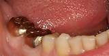 Pictures of Gold Teeth Dentist