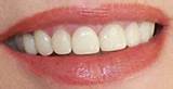 Porcelain Veneers Cost With Insurance