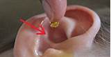 What Do Doctors Use To Remove Ear Wax