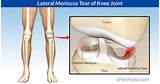 Images of Home Remedies For Knee Ligament Tears