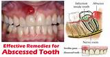 Images of Home Remedies For Dental Abscesses