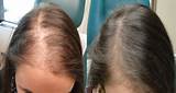 Photos of Prp Treatment For Alopecia