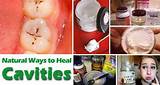 Home Remedies To Heal Cavities Photos