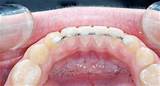 Images of Orthodontic Lingual Retainer Wire