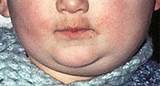 Photos of What Is The Treatment For Mumps Disease