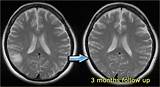 Pictures of Cerebral Venous Sinus Thrombosis Treatment