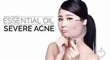 Images of What''s The Best Acne Treatment