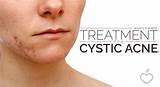 Photos of Best Home Treatment For Cystic Acne