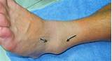 Pictures of Swollen Ankle Sprain Treatment
