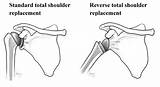 Shoulder Replacement Recovery Process