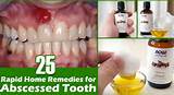 Photos of Tooth Infection Antibiotics Home Remedies
