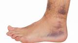 Images of Plantar Vein Thrombosis Treatment
