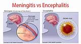 Viral Encephalitis Recovery Pictures