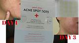 Acne Treatment Dots Photos