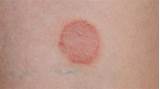 Ringworm Symptoms In Humans Mayo Clinic