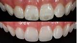 White Spot Removal Teeth Images