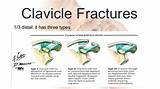 Pictures of Distal Clavicle Fracture Treatment