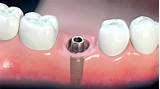 Dental Implants Indonesia Pictures