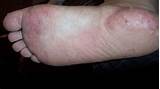 Pictures of Dyshidrotic Eczema Dyshidrotic Dermatitis Home Remedies