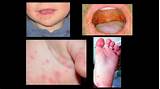 Hand Foot And Mouth Diaper Rash Treatment Pictures