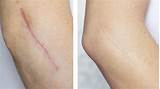 Photos of How To Hide Scars On Legs Without Makeup