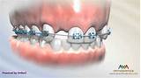 Orthodontic Treatment Photos