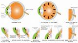 Best Glaucoma Doctors Images