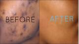 Dark Spot Removal Surgery Images
