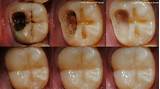 Photos of Colloidal Silver Root Canal