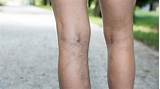 How Much Is Vein Treatment Images