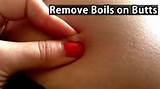 Boil Anus Home Remedies Images