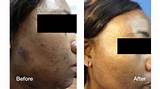 Photos of Laser Treatment For Black Skin